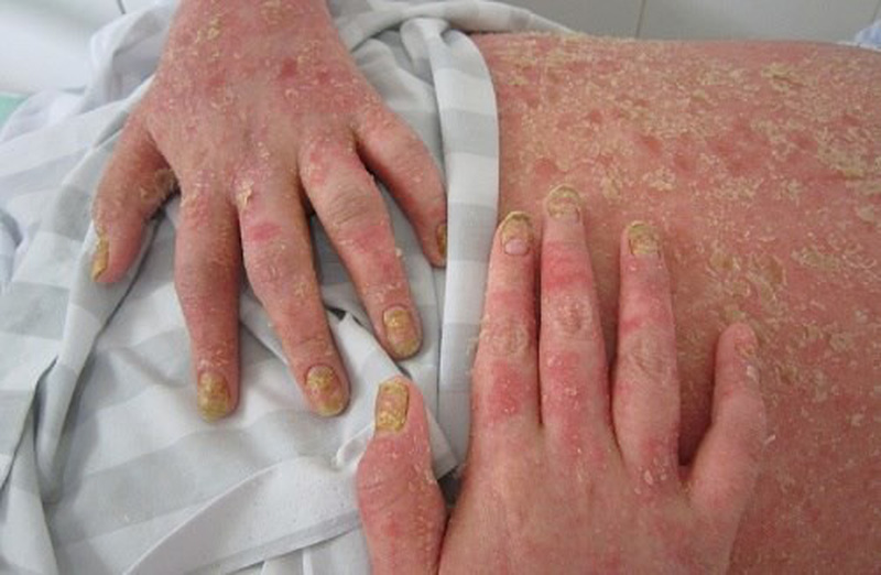 Viêm khớp vảy nến - Hình ảnh minh họa